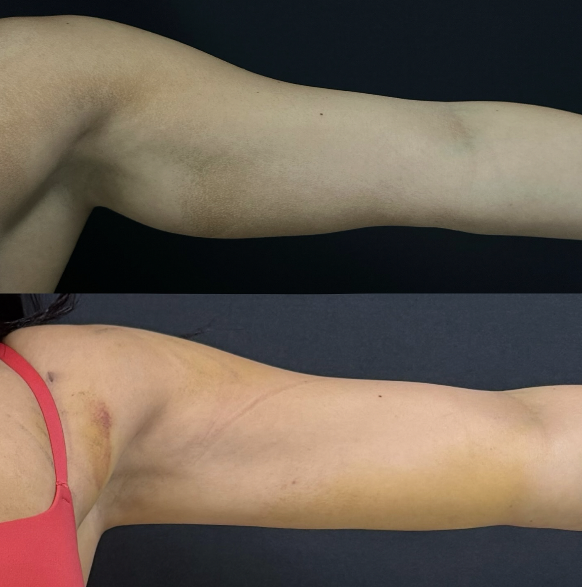 arm lipo 4